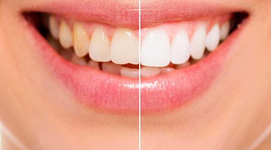 Branqueamento Dentário - comparação entre dentes amarelados e brancos.